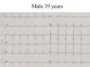 Picture of Brugada Syndrome