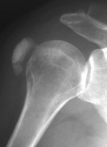 Image of Calcific Tendinitis