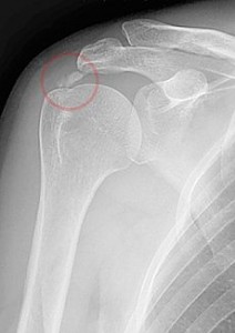 Picture of Calcific Tendinitis