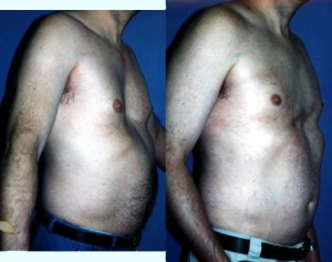 Image of Pectus excavatum