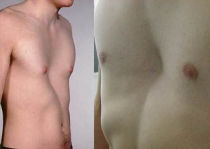 Picture of Pectus excavatum