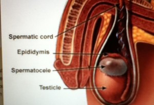 Image of Spermatocele