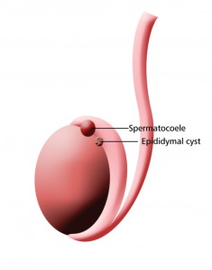 Picture of Spermatocele