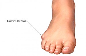 Image of Tailor's Bunion