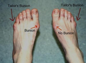 Picture of Tailor's Bunion