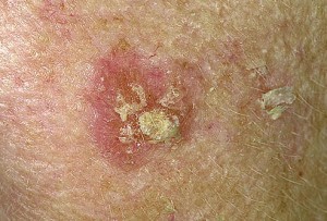 actinic keratosis picture