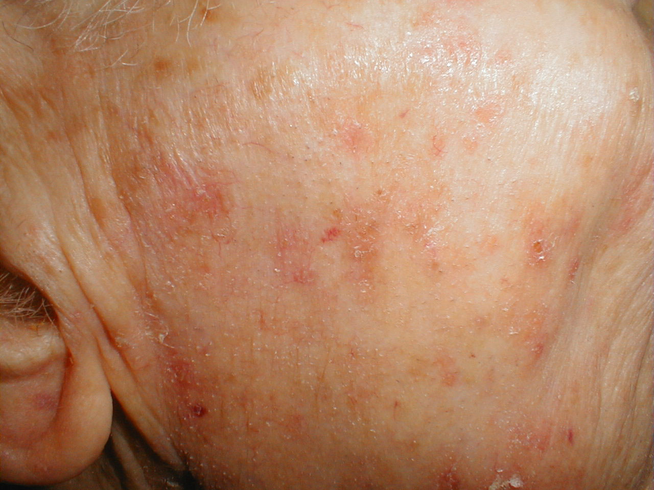 Imagees of Actinic Keratosis