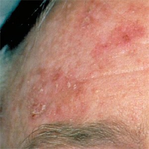 Photos of Actinic Keratosis