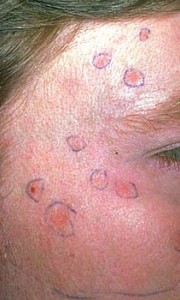 pictures of actinic keratosis
