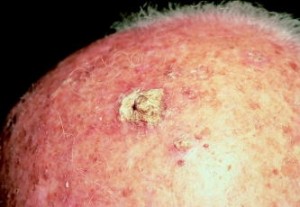 actinic keratosis on scalp Picture