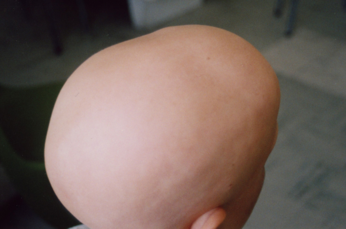Photos of Alopecia Totalis