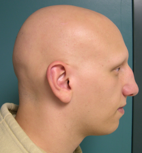 Alopecia Totalis Picture