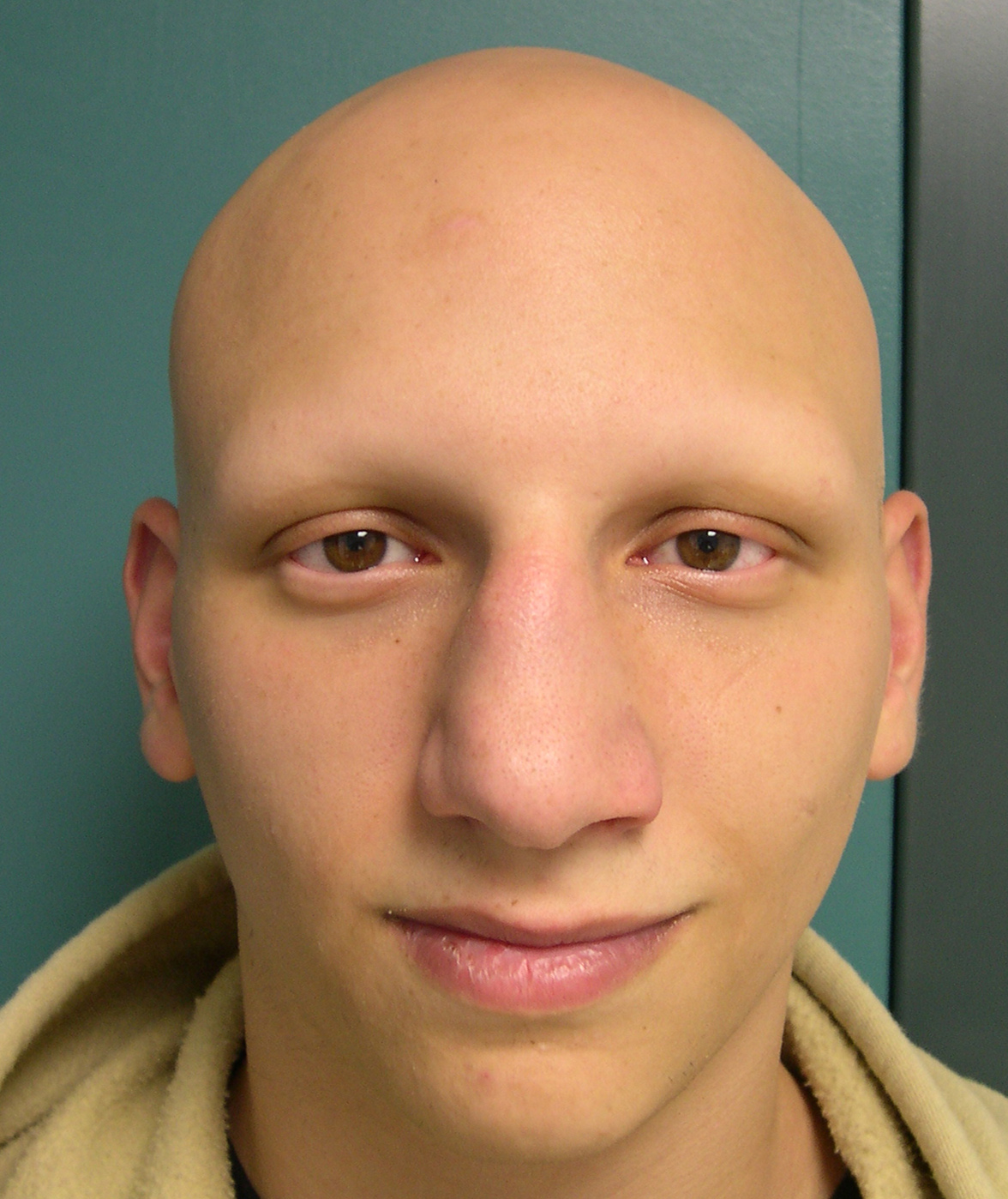 Alopecia Totalis Symptoms Causes And Treatment