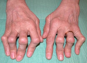 Picture of Chronic Polyarthritis