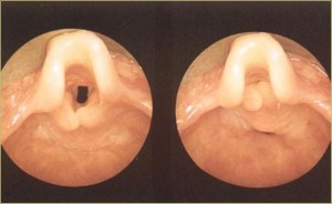 Image of Laryngomalacia