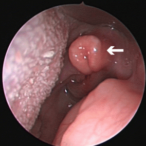 Picture of Laryngomalacia