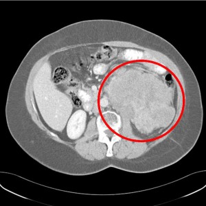 Image of Leiomyosarcoma