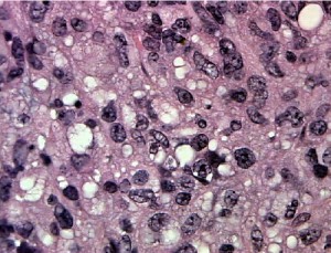 Image of Liposarcoma