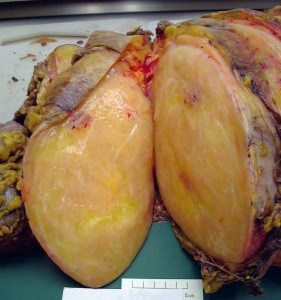 Picture of Liposarcoma