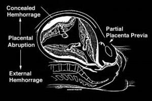 Image of Placental Abruption