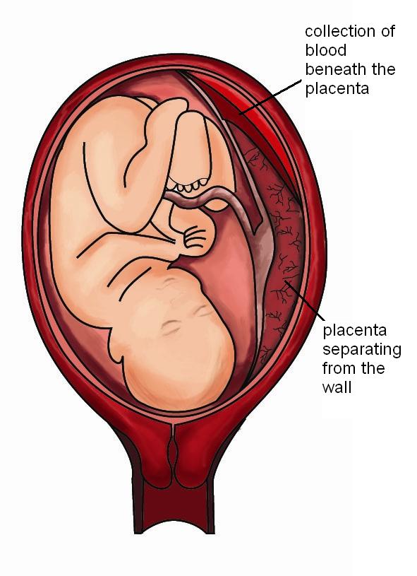 Picture of Placental Abruption