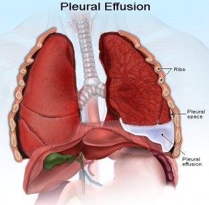 Image of Pleural effusion