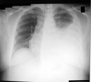 Picture of Pleural effusion