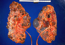 Picture of Polycystic kidney disease