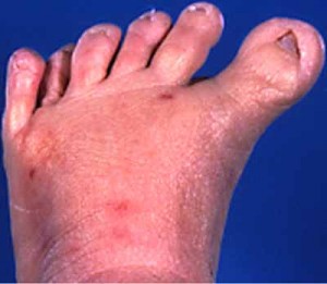 Image of Polydactyly