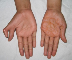 Picture of Polydactyly
