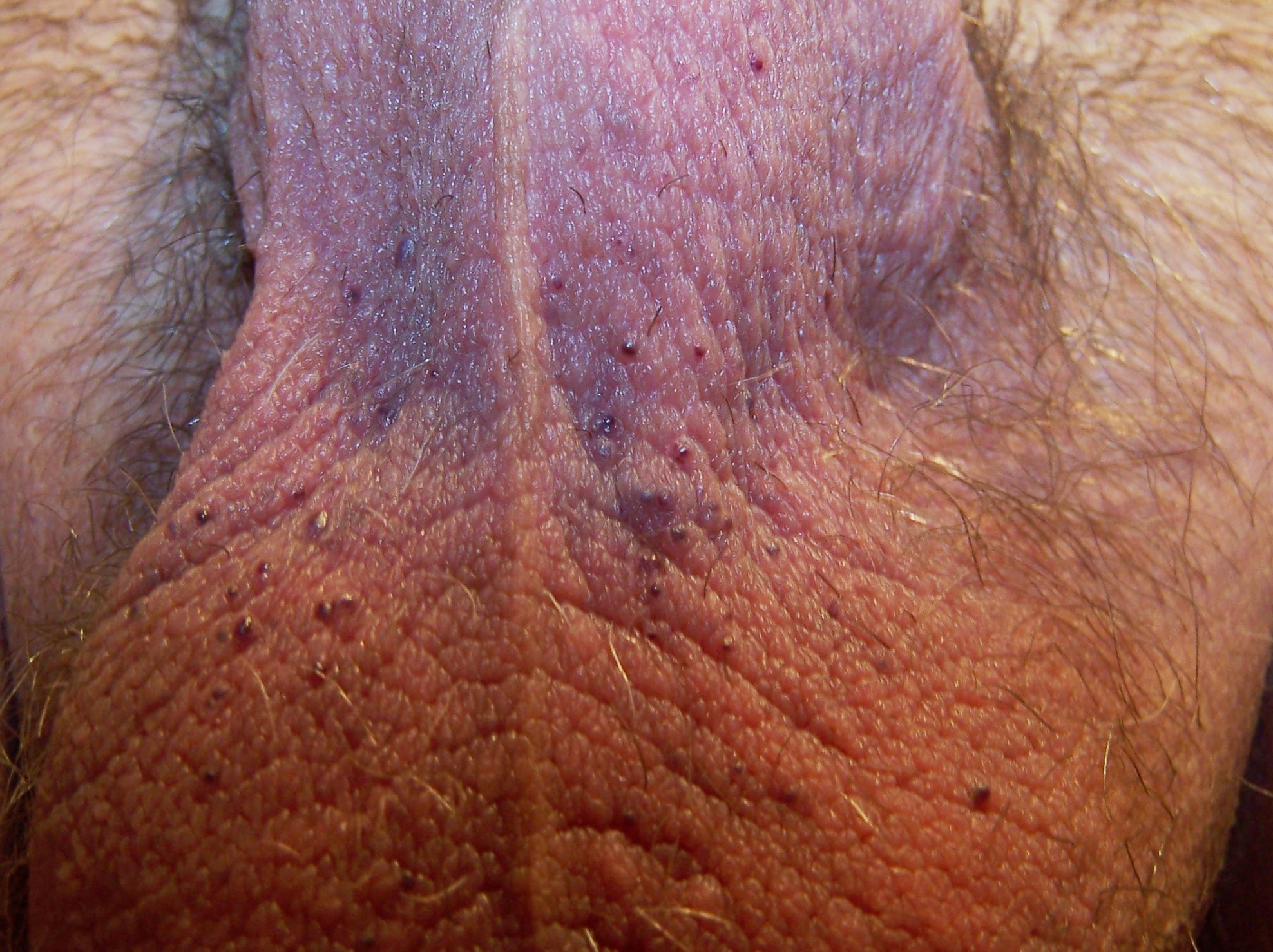 Angiokeratoma Penis 78