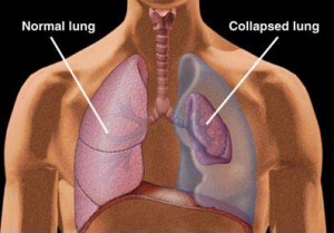 Image of Collapsed lung