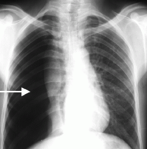 Picture of Collapsed lung