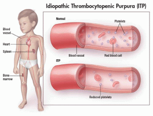 Idiopathic Thrombocytopenic Purpura Image