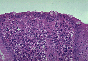 Picture of Lymphocytic colitis