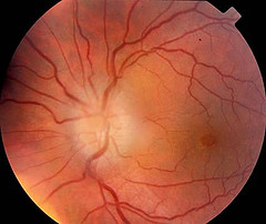 Picture of Optic neuritis