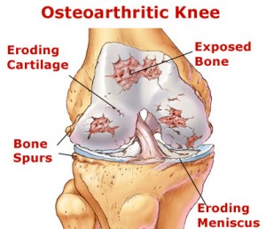 Image of Osteoarthritis