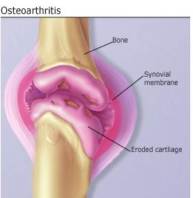 Picture of Osteoarthritis