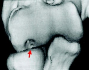 Image of Osteochondritis dissecans