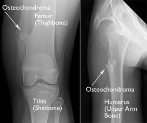 Image of Osteochondroma 