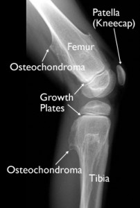 Picture of Osteochondroma