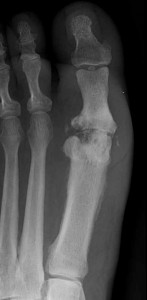 Image of Osteomyelitis