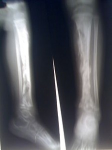 Picture of Osteomyelitis