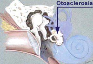 Image of Otosclerosis