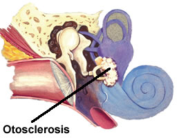 Picture of Otosclerosis