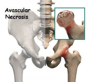 Picture of Avascular necrosis