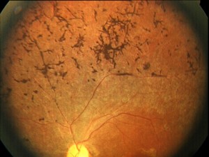 Image of Retinitis pigmentosa