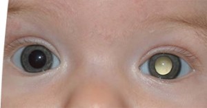 Picture of Retinoblastoma