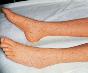 Image of Rocky Mountain spotted fever