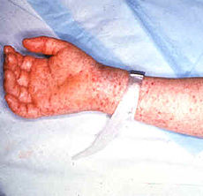 Picture of Rocky Mountain spotted fever